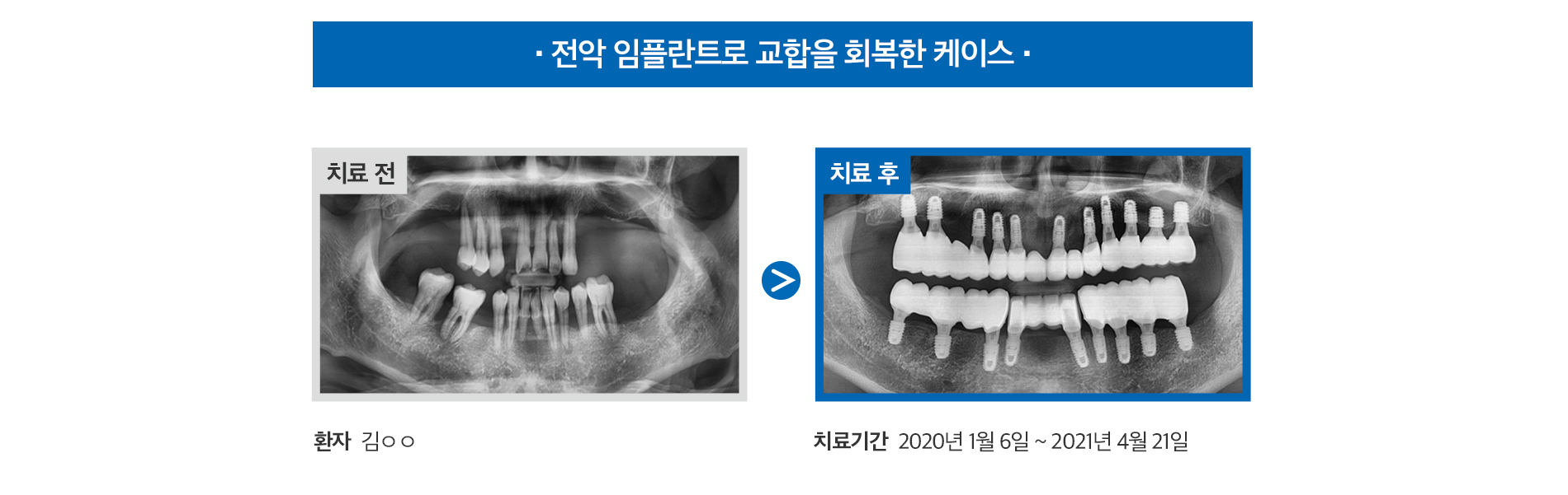 전악 임플란트로 교합을 회복한 케이스