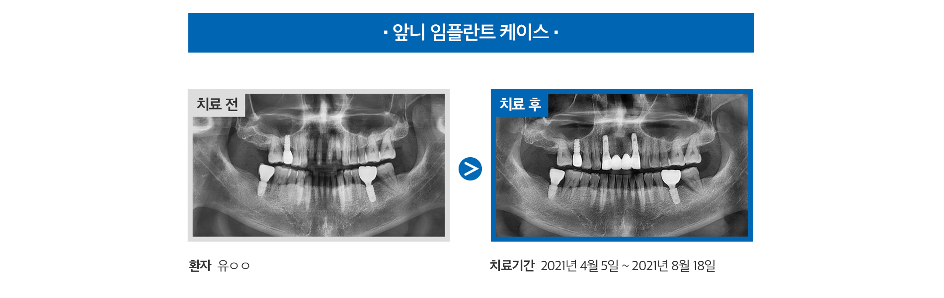 앞니 임플란트 케이스