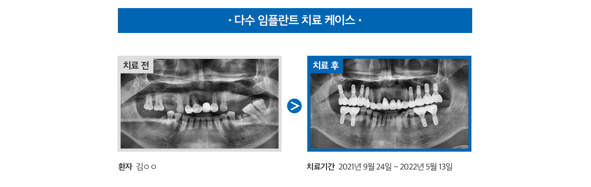 다수 임플란트 치료 케이스