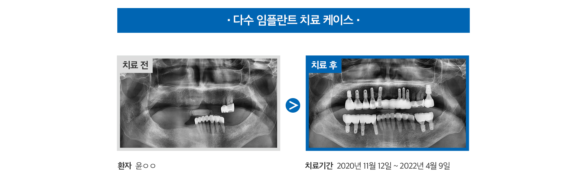 앞니 임플란트 케이스